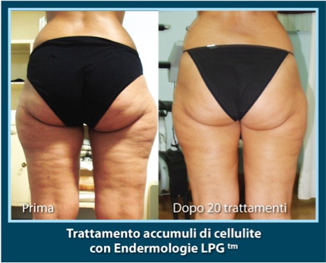 StudioPonzano-CelluliteEndermologieLPG