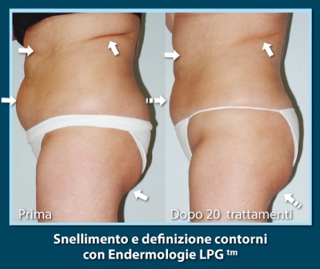 StudioPonzano-SnellimentoEndermologieLPG
